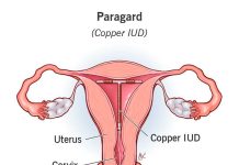 Family Planning and Infections: Safe Choices Every Woman Should Know Copper intrauterine device (IUD) inside the uterus for long-term, hormone-free contraception