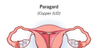 Copper intrauterine device (IUD) inside the uterus for long-term, hormone-free contraception