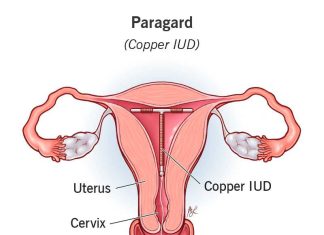 Copper intrauterine device (IUD) inside the uterus for long-term, hormone-free contraception