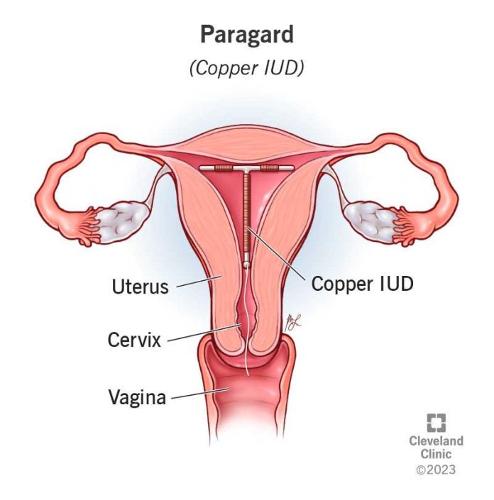 Copper Intrauterine Device (IUD) for Long-Term Family Planning Copper intrauterine device (IUD) inside the uterus for long-term, hormone-free contraception