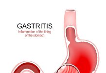 Stomach inflammation showing gastritis with stomach pain and indigestion