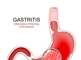 Stomach inflammation showing gastritis with stomach pain and indigestion