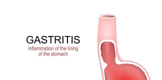 Stomach inflammation showing gastritis with stomach pain and indigestion