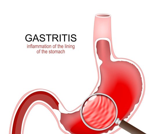 Foods to avoid or use with caution when you have gastritis Stomach inflammation showing gastritis with stomach pain and indigestion