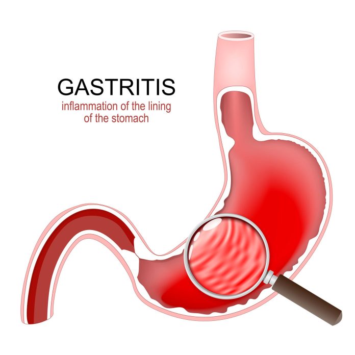 Stomach inflammation showing gastritis with stomach pain and indigestion
