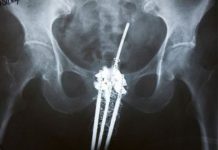 Brachytherapy treatment showing radiation delivered directly to cervical cancer