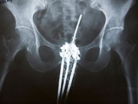 Brachytherapy treatment showing radiation delivered directly to cervical cancer